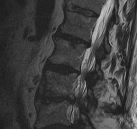 Lumbar Disc Degeneration Modic Changes